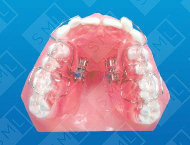 Class-II-Division-2-Sagittal-Appliance