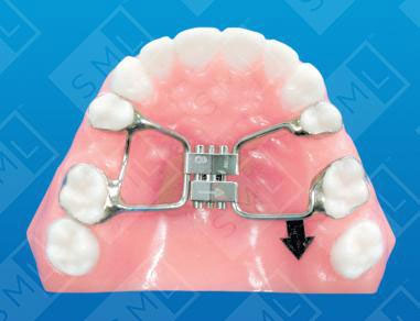 Fixed-Unilateral-Distalizer