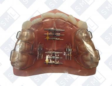 Four-Screw-Sagittal