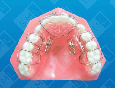 Pre-Maxillary-Development-Sagittal-with-Frankel-Pads